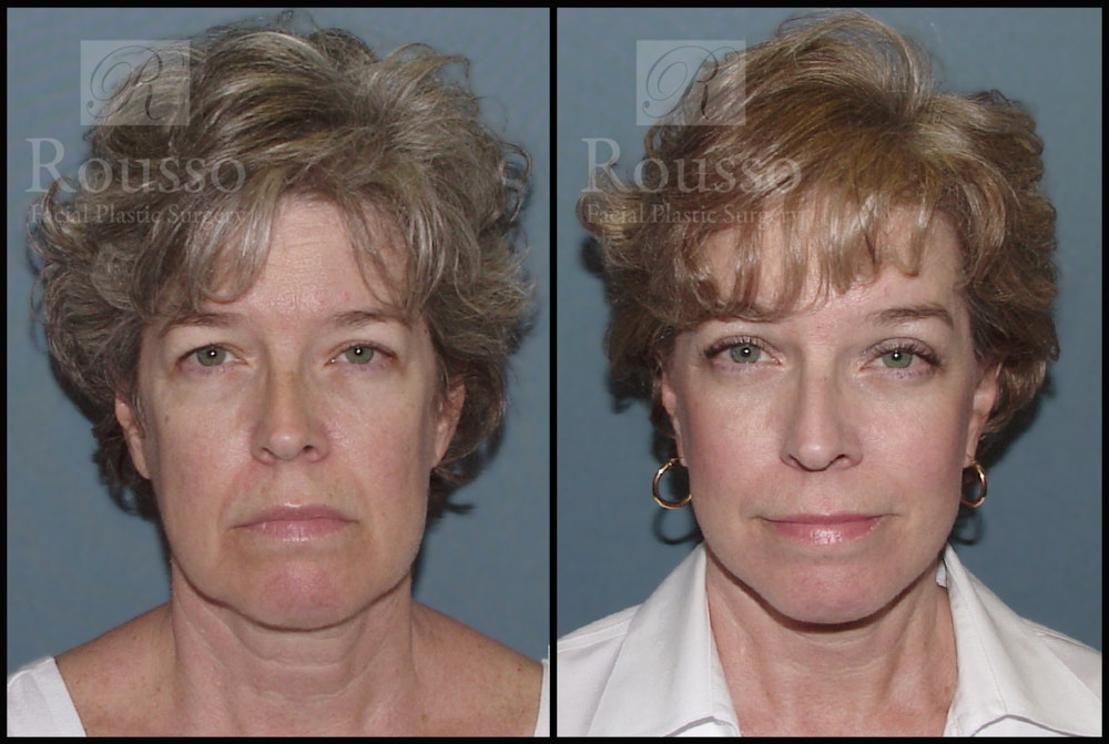 Facelift Before & After Gallery - Patient 1993274 - Image 3