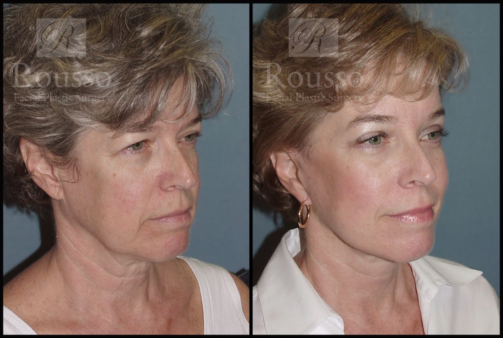 Facelift Before & After Gallery - Patient 1993274 - Image 1