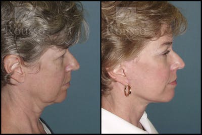Facelift Before & After Gallery - Patient 1993274 - Image 2