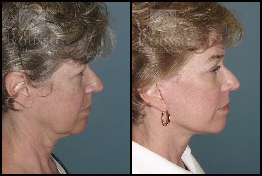Facelift Before & After Gallery - Patient 1993274 - Image 2