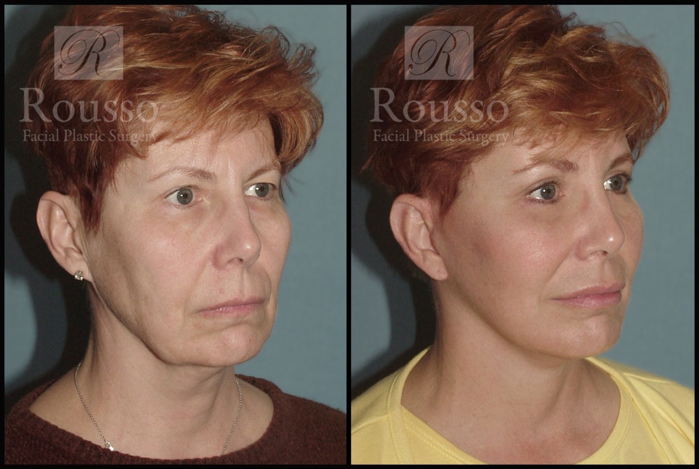 Facelift Before & After Gallery - Patient 1993292 - Image 1