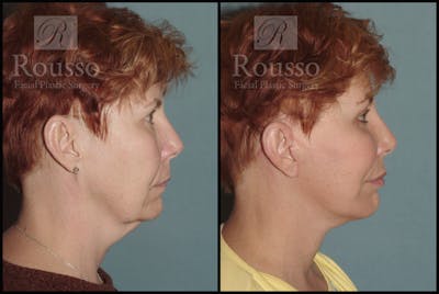 Facelift Before & After Gallery - Patient 1993292 - Image 2