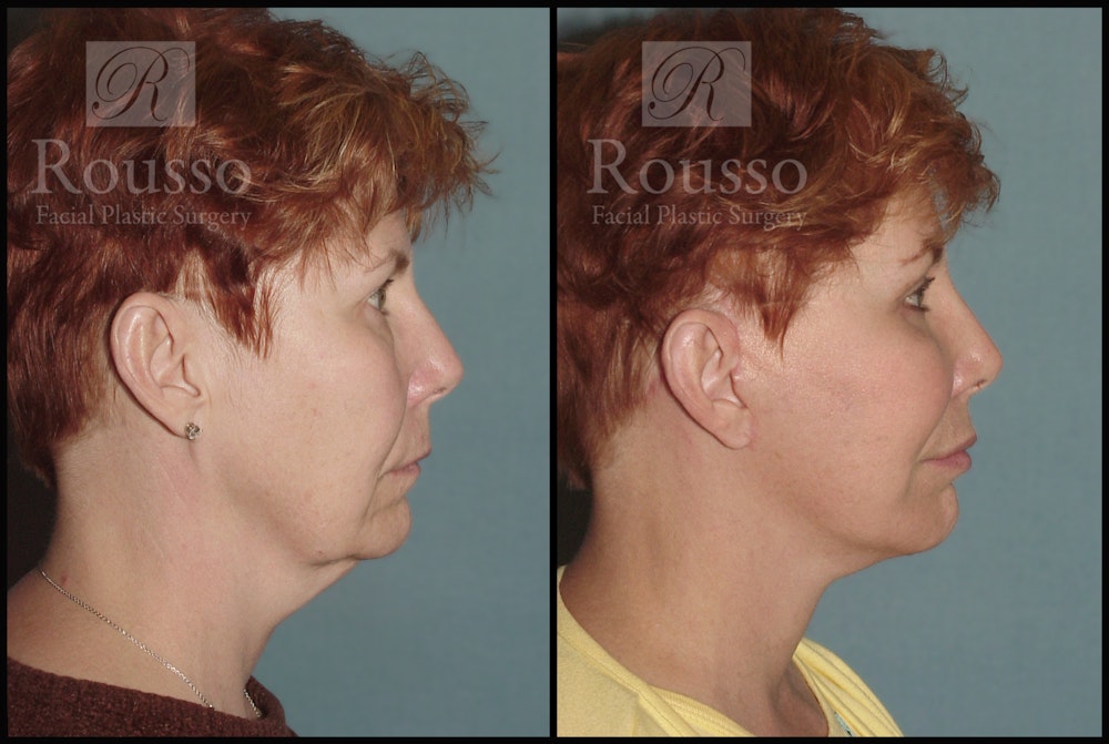 Facelift Before & After Gallery - Patient 1993292 - Image 2