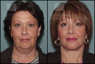 SculptLift™ Before & After Gallery - Patient 2236440 - Image 1