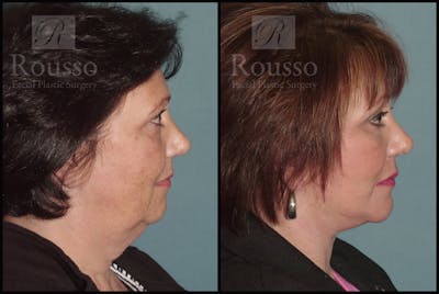 SculptLift™ Before & After Gallery - Patient 2236440 - Image 2