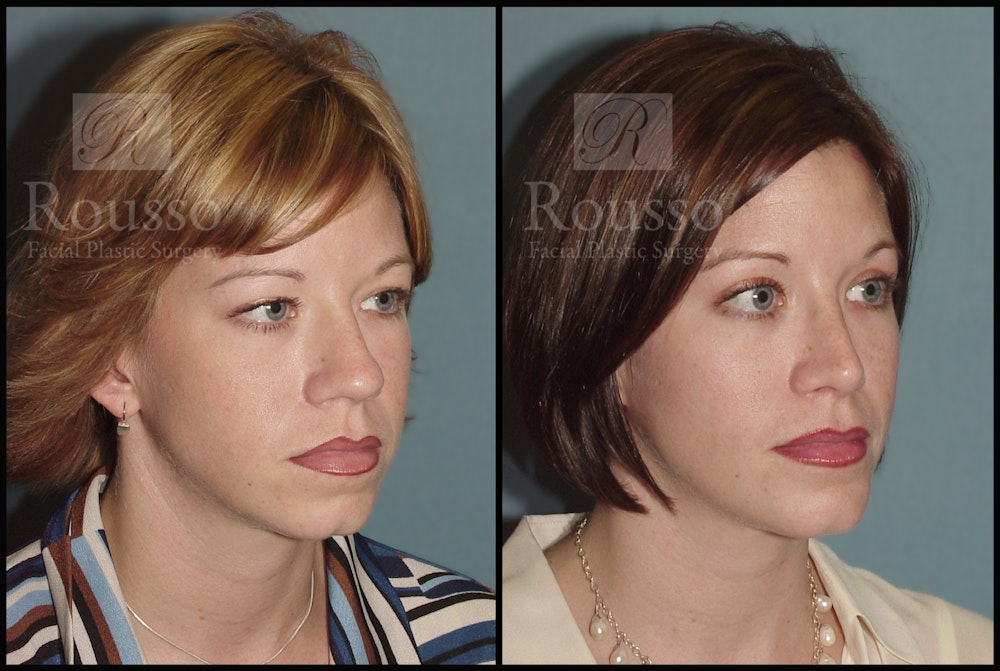 Blepharoplasty Before & After Gallery - Patient 1993307 - Image 3