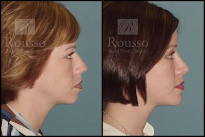 Blepharoplasty <span class=small>By Dr. Daniel Rousso</span> Before & After Gallery - Patient 1993307 - Image 2