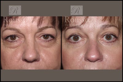 Blepharoplasty <span class=small>By Dr. Daniel Rousso</span> Before & After Gallery - Patient 1993314 - Image 1
