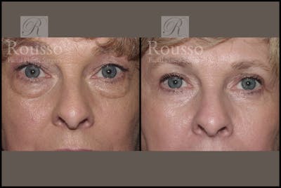 Blepharoplasty Before & After Gallery - Patient 1993309 - Image 1