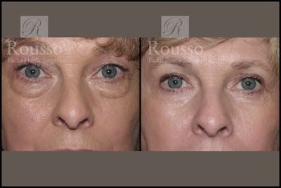 Blepharoplasty <span class=small>By Dr. Daniel Rousso</span> Before & After Gallery - Patient 1993309 - Image 1