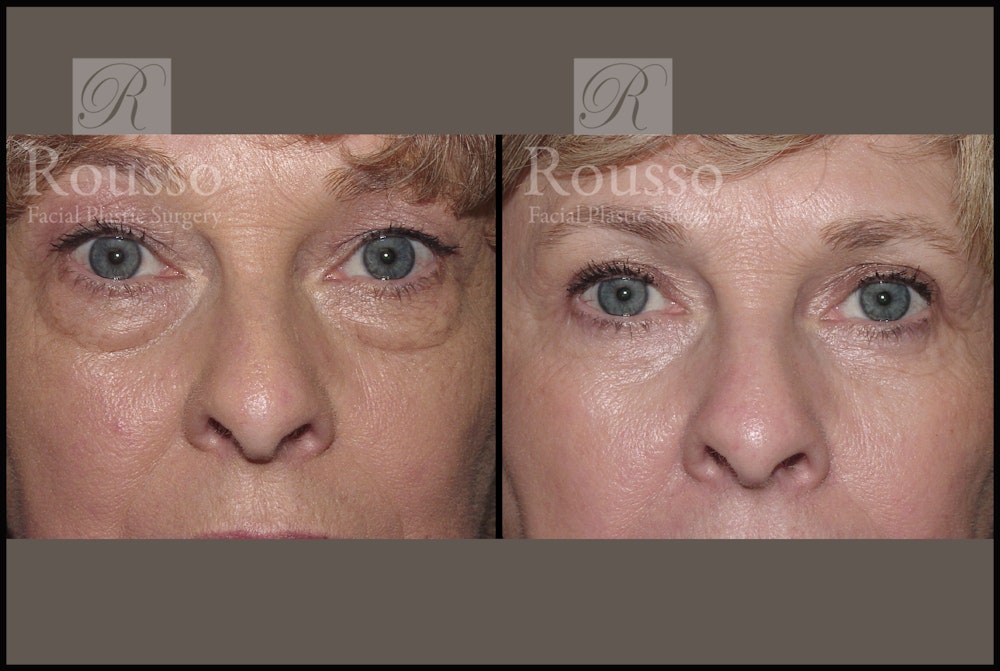 Blepharoplasty <span class=small>By Dr. Daniel Rousso</span> Before & After Gallery - Patient 1993309 - Image 1
