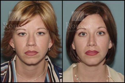 Blepharoplasty Before & After Gallery - Patient 1993307 - Image 1