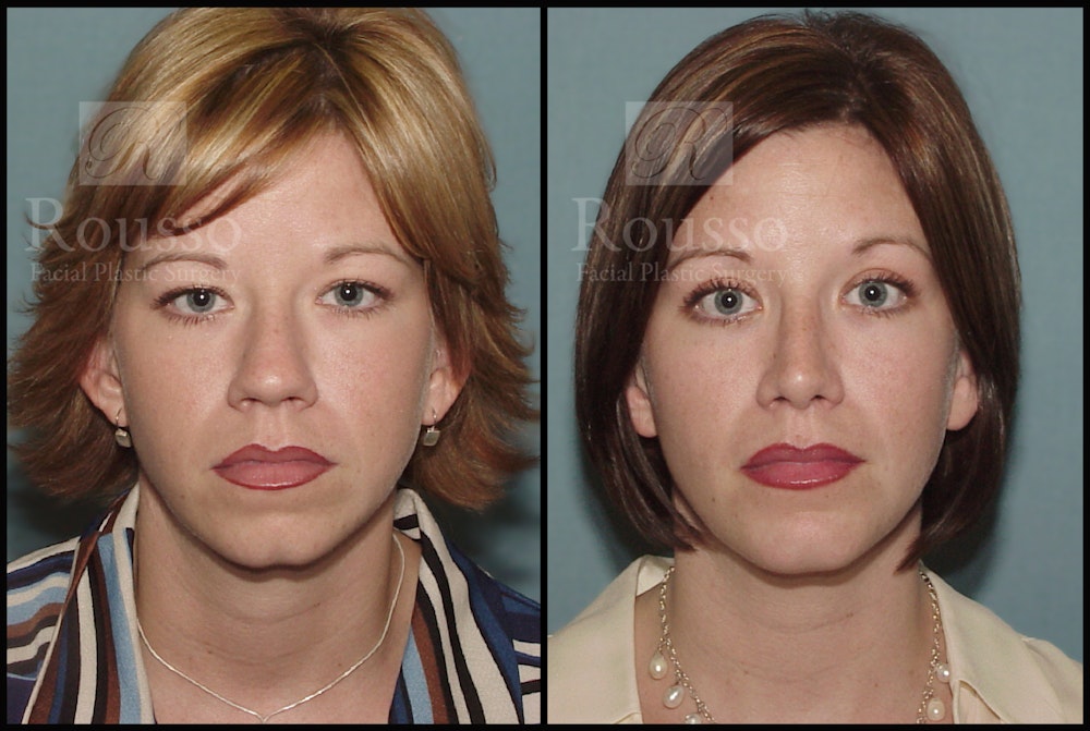 Blepharoplasty Before & After Gallery - Patient 1993307 - Image 1