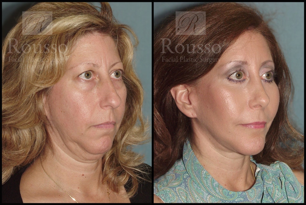 Blepharoplasty Before & After Gallery - Patient 2029502 - Image 3