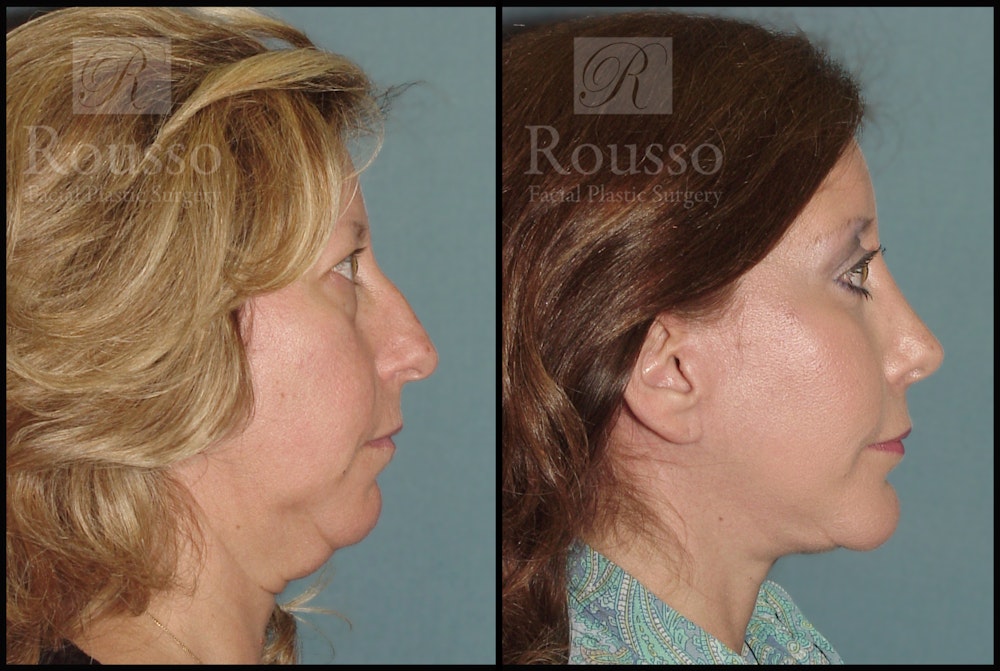 Blepharoplasty Before & After Gallery - Patient 2029502 - Image 4