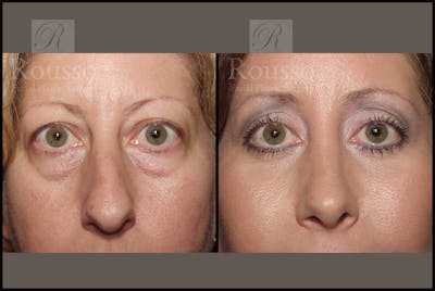 Blepharoplasty <span class=small>By Dr. Daniel Rousso</span> Before & After Gallery - Patient 2029502 - Image 1