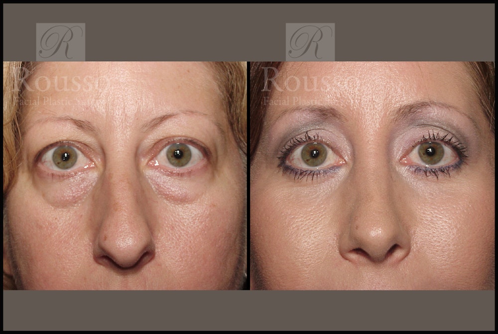 Blepharoplasty Before & After Gallery - Patient 2029502 - Image 1