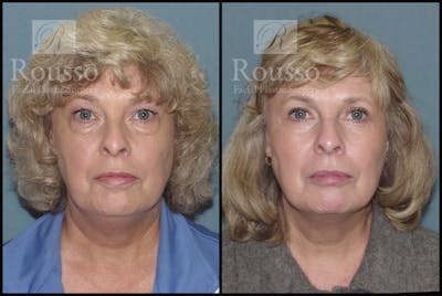 Blepharoplasty <span class=small>By Dr. Daniel Rousso</span> Before & After Gallery - Patient 2216936 - Image 1