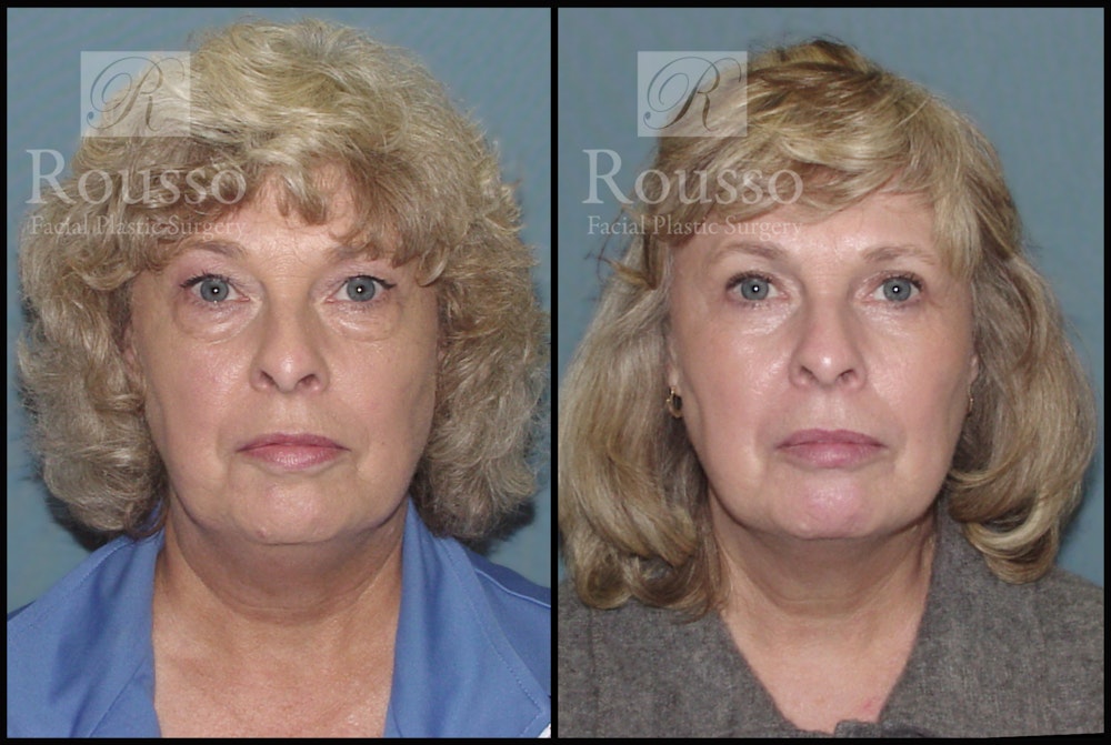 Blepharoplasty <span class=small>By Dr. Daniel Rousso</span> Before & After Gallery - Patient 2216936 - Image 1