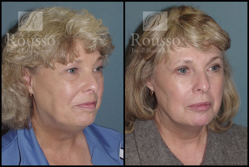 Blepharoplasty Before & After Gallery - Patient 2216936 - Image 2