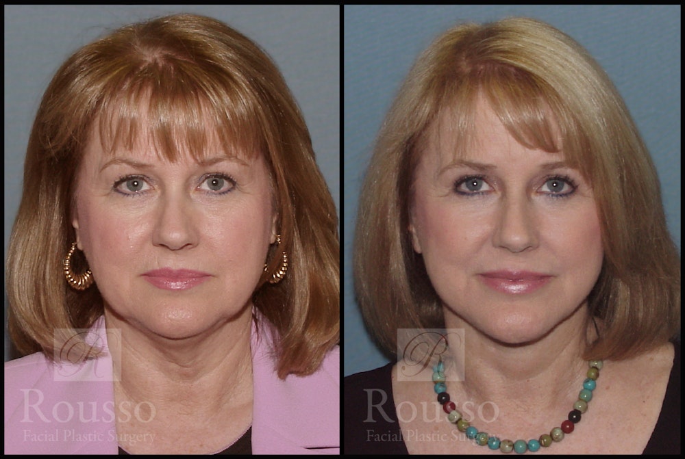 Facelift Before & After Gallery - Patient 2216940 - Image 3