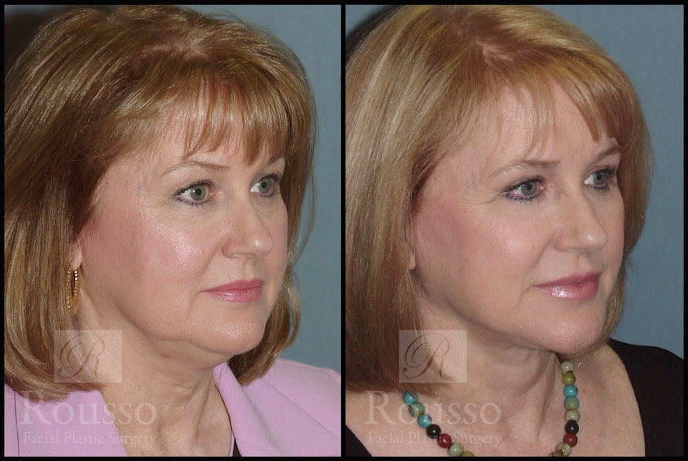 Facelift Before & After Gallery - Patient 2216940 - Image 1