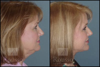 Facelift Before & After Gallery - Patient 2216940 - Image 2