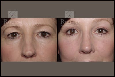 Blepharoplasty Before & After Gallery - Patient 2236571 - Image 1