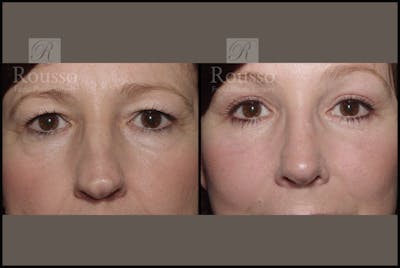 Blepharoplasty <span class=small>By Dr. Daniel Rousso</span> Before & After Gallery - Patient 2236571 - Image 1