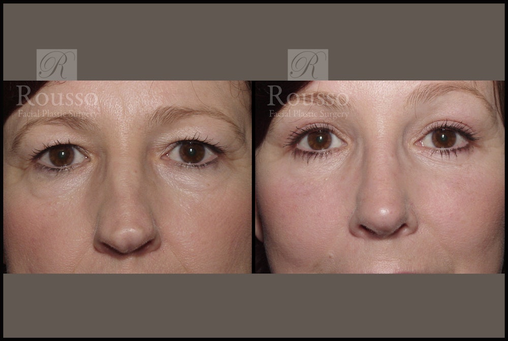 Blepharoplasty <span class=small>By Dr. Daniel Rousso</span> Before & After Gallery - Patient 2236571 - Image 1