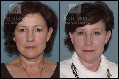 SculptLift™ Before & After Gallery - Patient 2236583 - Image 1