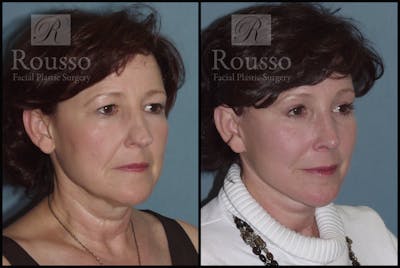 SculptLift™ Before & After Gallery - Patient 2236583 - Image 2