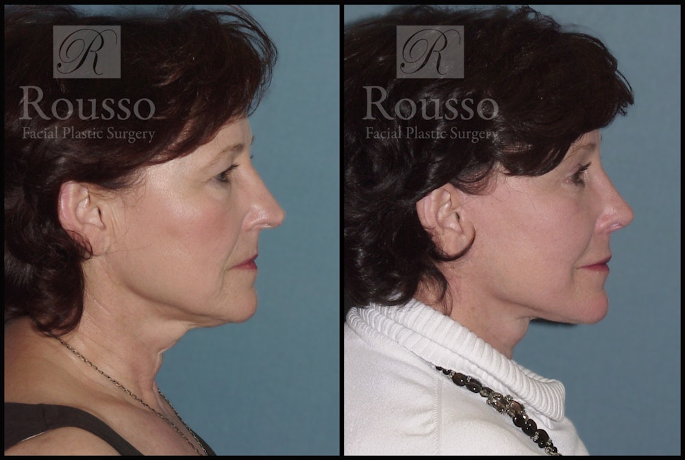 SculptLift™ Before & After Gallery - Patient 2236583 - Image 3