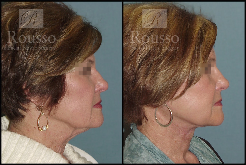 Facelift Before & After Gallery - Patient 2236644 - Image 2