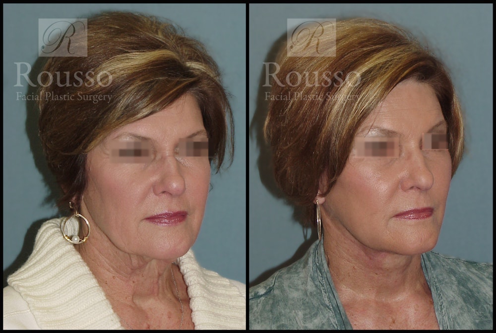 Facelift Before & After Gallery - Patient 2236644 - Image 1
