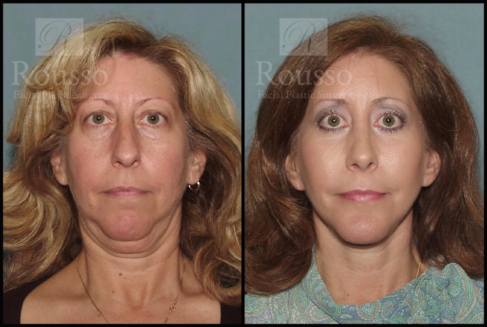 Facelift Before & After Gallery - Patient 2237786 - Image 3