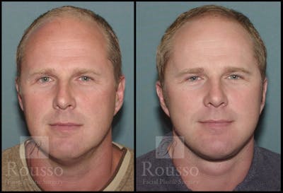 Male Facelift Before & After Gallery - Patient 2236799 - Image 1