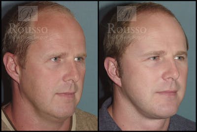Male Facelift Before & After Gallery - Patient 2236799 - Image 2