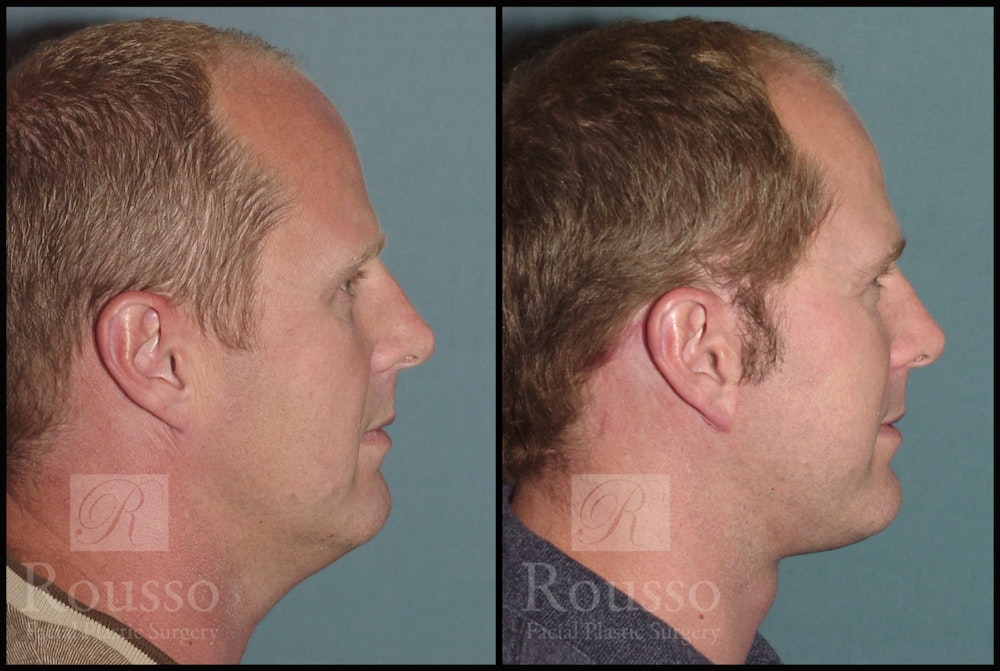 Male Facelift Before & After Gallery - Patient 2236799 - Image 3