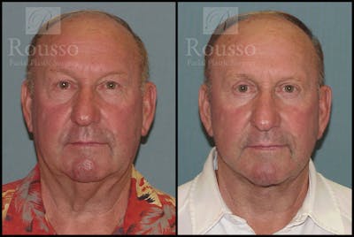 Male Facelift Before & After Gallery - Patient 2236800 - Image 1