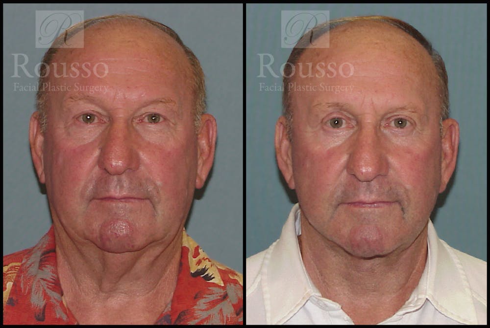 Male Facelift Gallery - Patient 2236800 - Image 1
