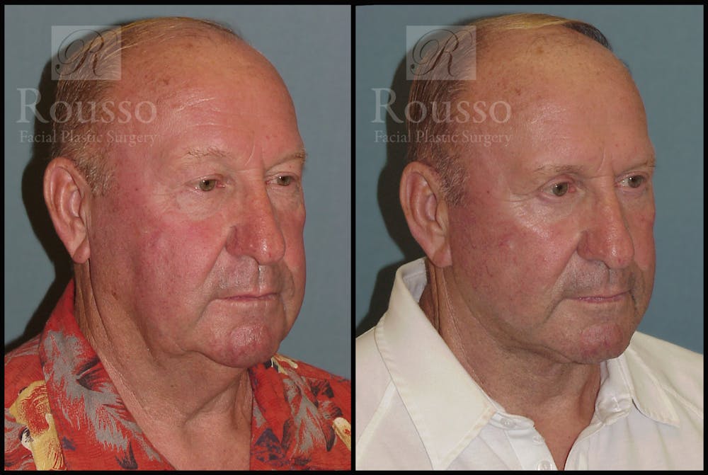 Male Facelift Gallery - Patient 2236800 - Image 2