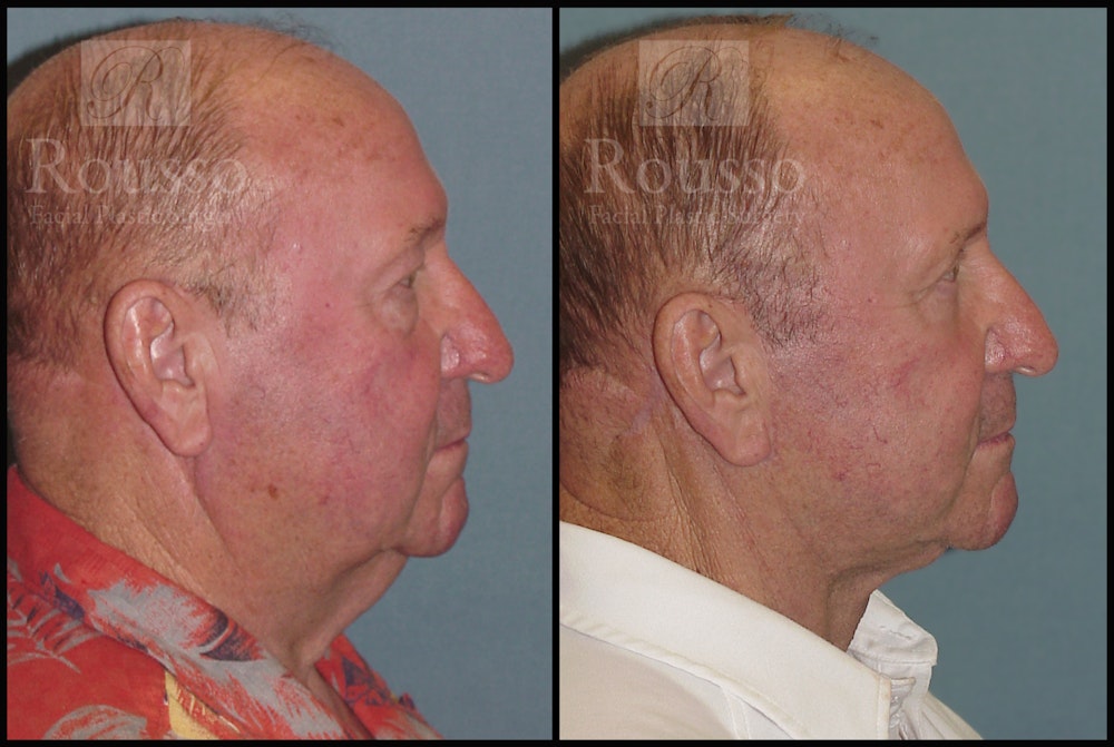 Male Facelift Before & After Gallery - Patient 2236800 - Image 3