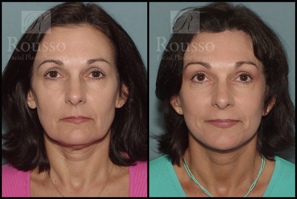 Facelift Before & After Gallery - Patient 273505 - Image 3