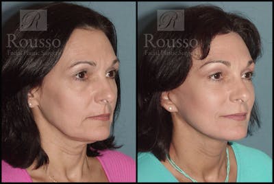 Facelift Before & After Gallery - Patient 273505 - Image 1