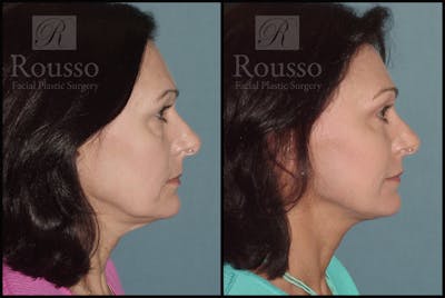 Facelift - Dr. Rousso Before & After Gallery - Patient 273505 - Image 2