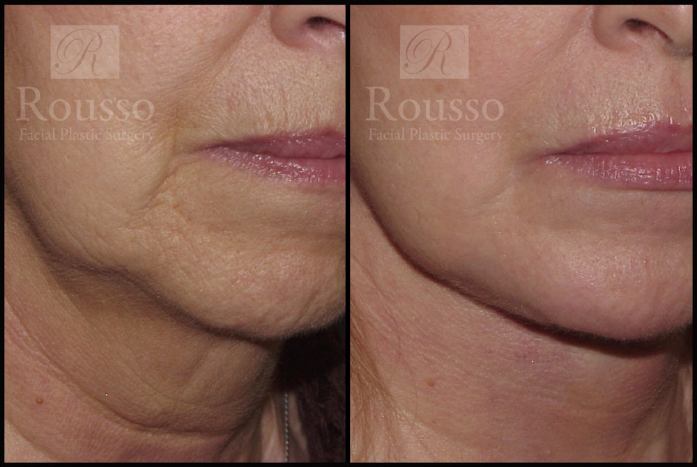 Facelift Before & After Gallery - Patient 2236803 - Image 4
