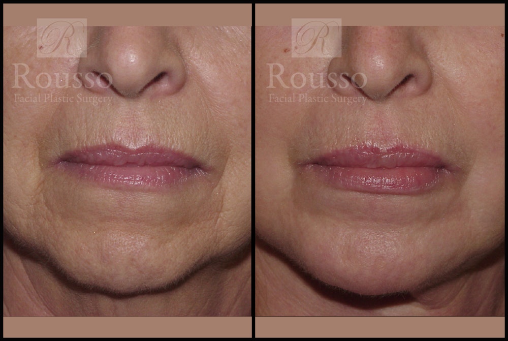 Facelift Before & After Gallery - Patient 2236803 - Image 5