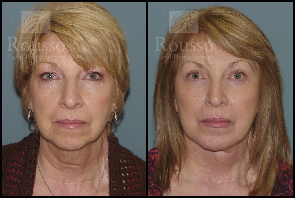 Facelift Before & After Gallery - Patient 2236803 - Image 3