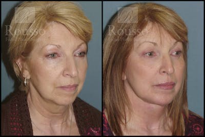 Facelift Before & After Gallery - Patient 2236803 - Image 1